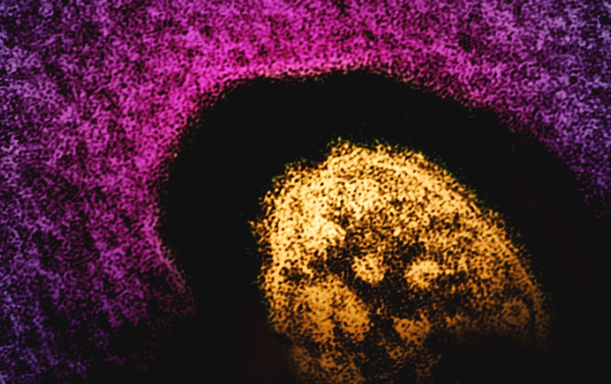 A colorized transmission electron micrograph of a measles virus particle. Source: Global Biodefense